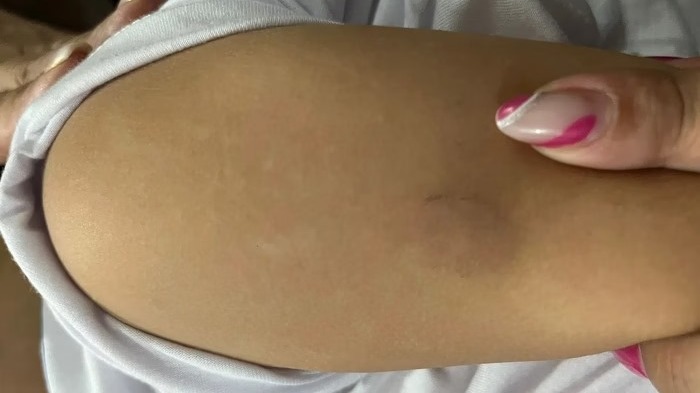 Cuidadora de escola infantil é demitida após morder braço de criança